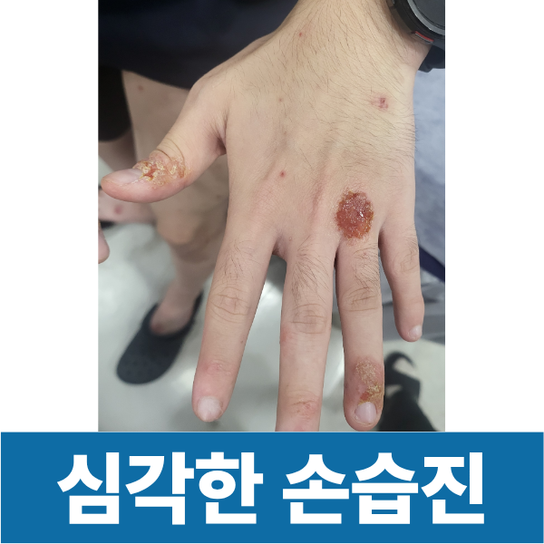 심각한 손습진 손은 사용을 많이하고 물이 닿아 불편합니다