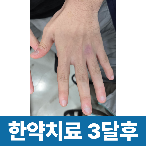 손습진 한약치료 3달 후 모습입니다 불편함과 통증이 사라져서 좋아하십니다