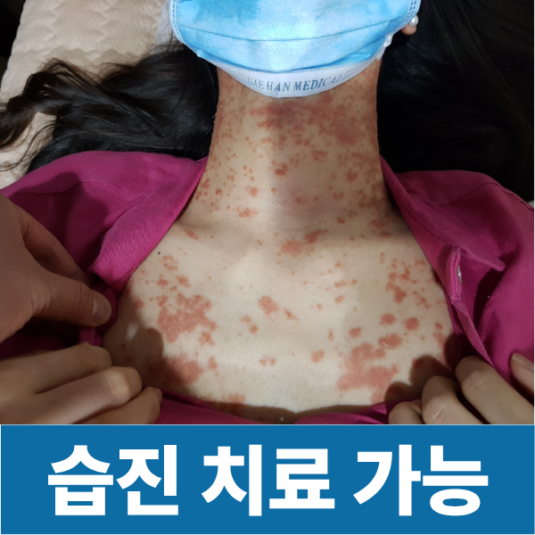 습진 피부병은 나을 수 있는 질환입니다 치료가능합니다